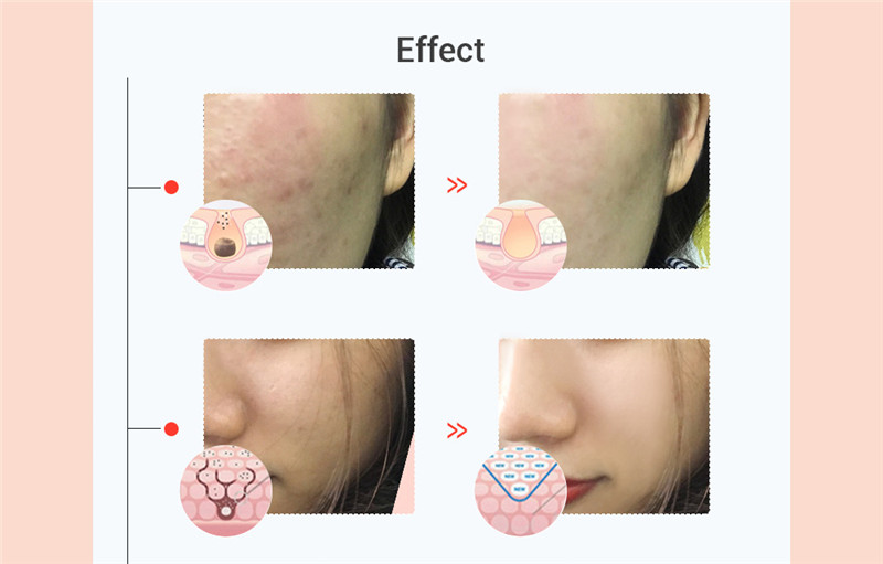Electronic Mask Rejuvenation Instrument Electronic Mask Rejuvenation Instrument