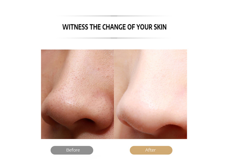 K_SKIN KD8023 Ultrasonic Blackhead Acne Removal Pore Cleaner K_SKIN KD8023 Ultrasonic Blackhead Acne Removal Pore Cleaner